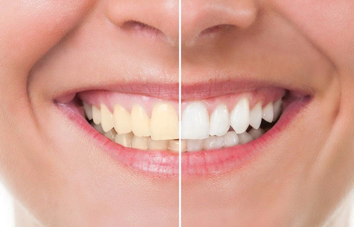 Professional Teeth Whitening