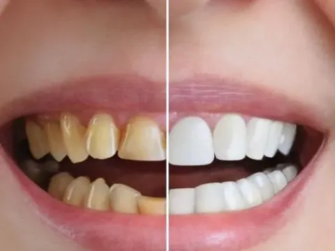 Cosmetic Dentistry in Al Ain – 3