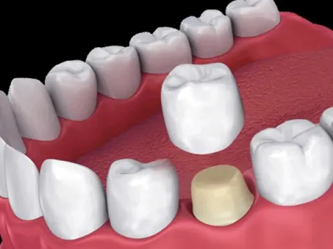 Dental Crowns in Al Ain – 1