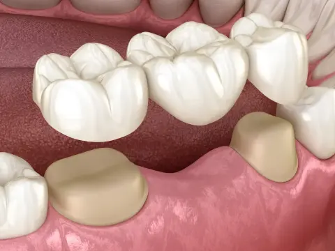 Dental Crowns in Al Ain – 2