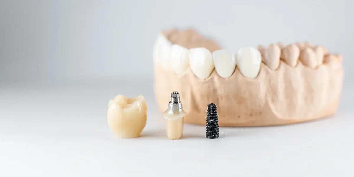 Dental Crowns in Al Ain