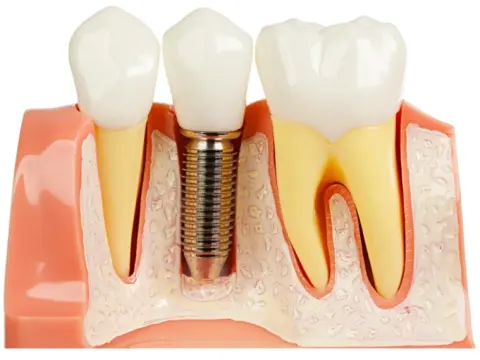 Dental Implants in Al Ain – 1