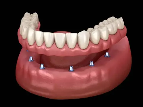Dental Implants in Al Ain – 2