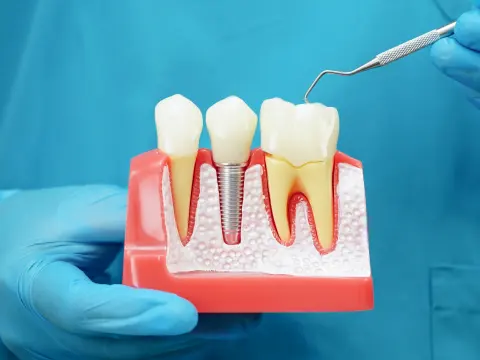 Dental Implants in Al Ain – 3