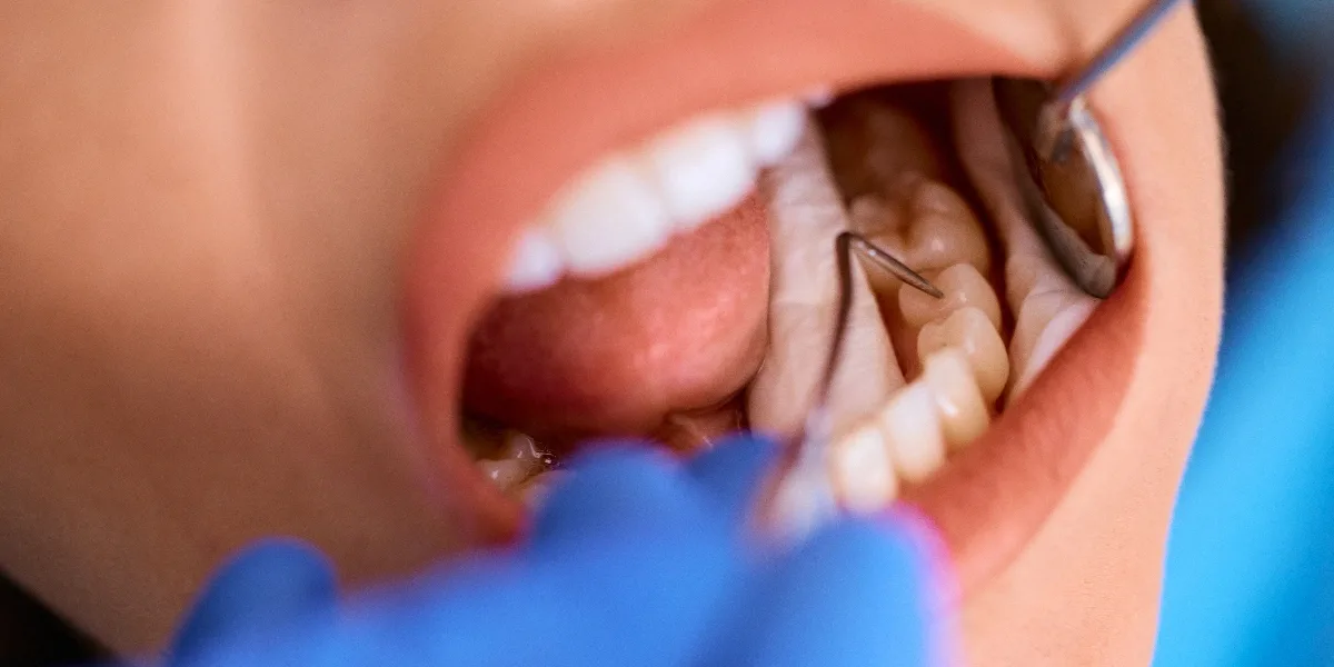 Dental Filling in Al Ain