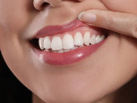 Gum Disease Treatment in Al Ain – 1