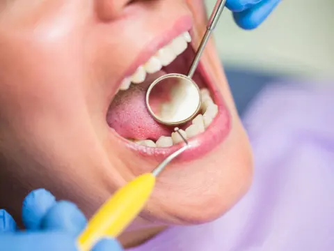 Gum Disease Treatment in Al Ain – 3