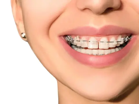 Expert Orthodontic Care in Al Ain – 1