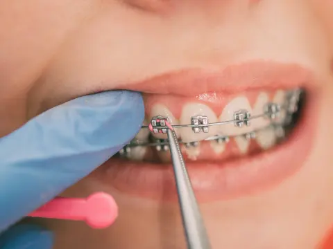Expert Orthodontic Care in Al Ain – 2