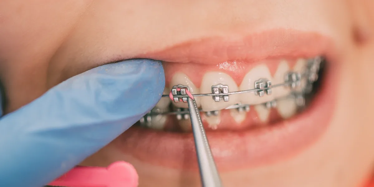 Expert Orthodontic Care in Al Ain