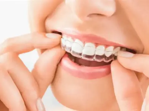 Retainers in Al Ain – 1