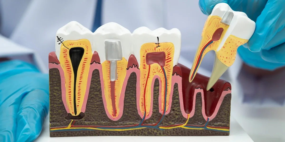 Root Canal Treatment in Al Ain
