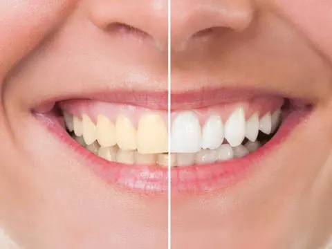 Teeth Whitening in Al Ain – 4