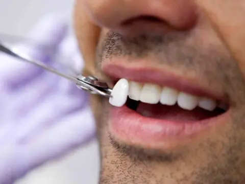 Dental Veneers in Al Ain – 1
