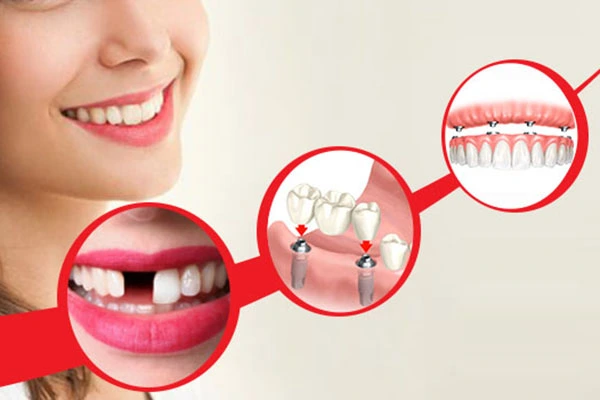 Implants - Dental Centre in Al Ain